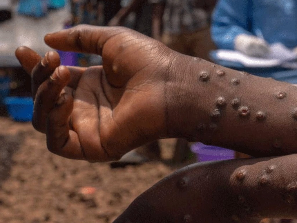 Togo: Mpox 8 cas confirmés, les autorités activent la surveillance sanitaire à Lomé